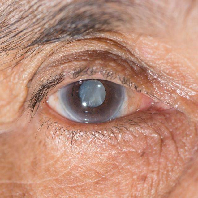 Афакия глаза: причины, симптомы и методы лечения