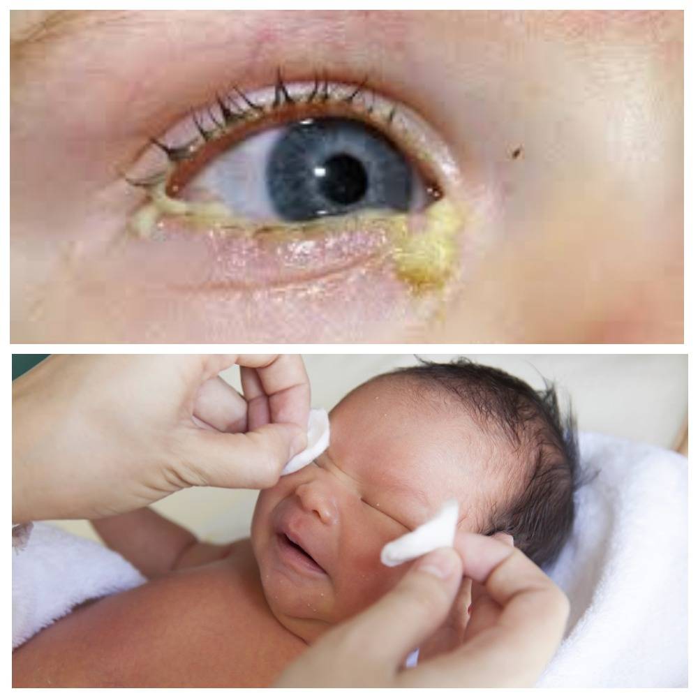 Выделения из глаза у ребенка и новорожденного грудничка