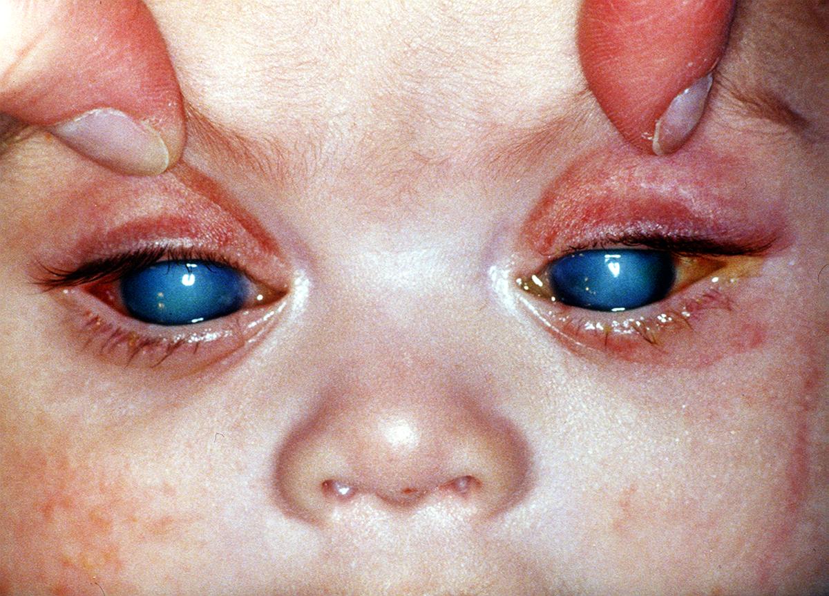 Что такое глаукома у ребенка врожденная