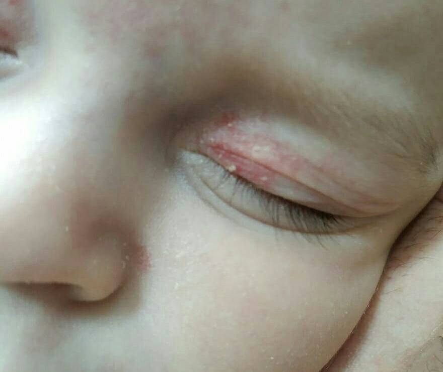 Повод насторожиться: причины красных сосудов в глазах у детей