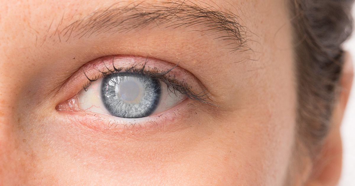 Причины помутнения в глазах, лечение и профилактика патологии