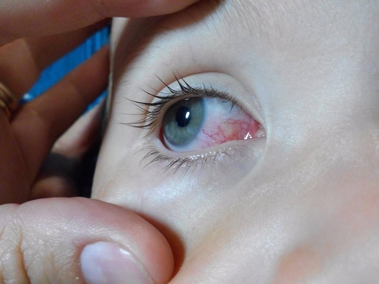 У ребенка красные глаза - причины, что делать и как лечить патологию