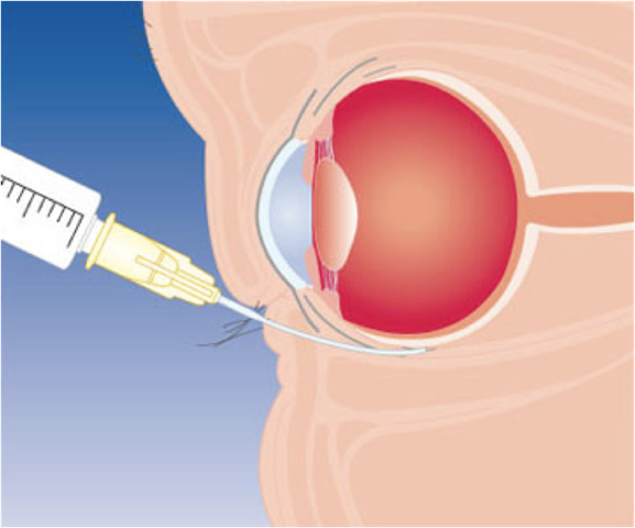 Инъекции в глаза при глаукоме - вылечимглаукому