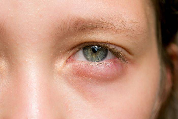 Гнойный конъюнктивит у детей: лечение глаз, как лечить при остром процессе