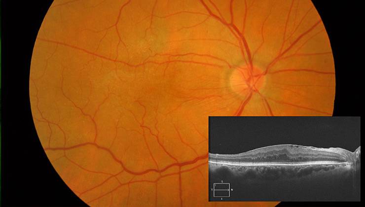 Что такое эпиретинальный фиброз глаз. народные рецепты для лечение фиброза сетчатки глаза