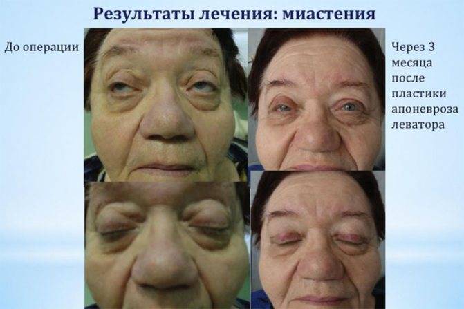 Миопатия - что это такое: причины, симптомы и лечение