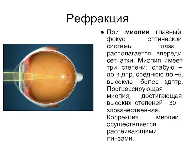 Миопия – что это такое? миопия глаза слабой, средней, высокой степени – как улучшить зрение при близорукости?