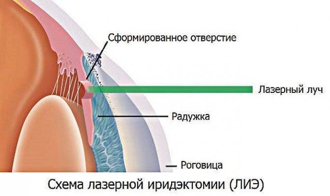 Лазерная иридэктомия (иридотомия)