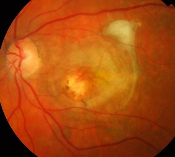 Хориоретинит: разновидности, симптомы, лечение - "здоровое око"