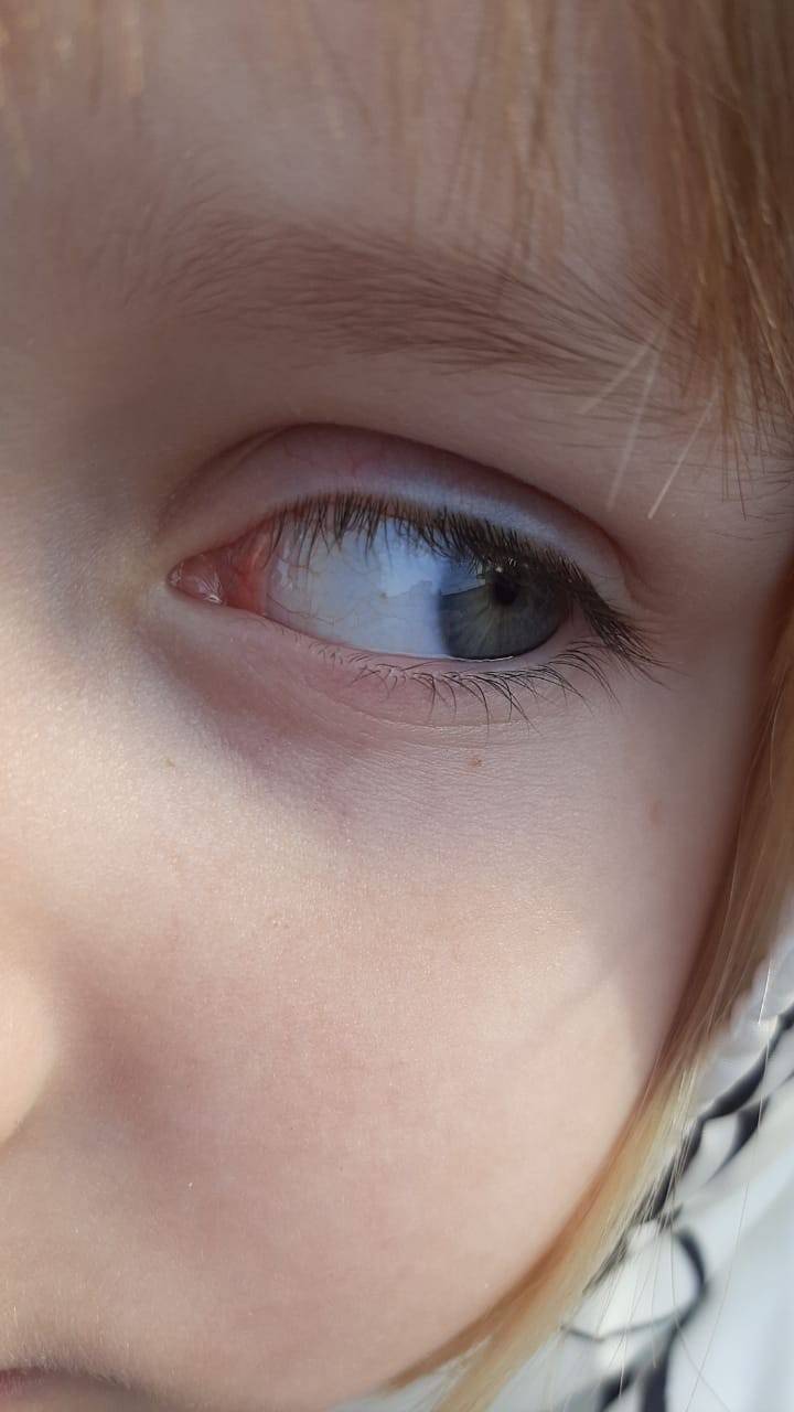 Из-за чего бывают голубыми белки глаз? симптомы, диагностика и лечение
