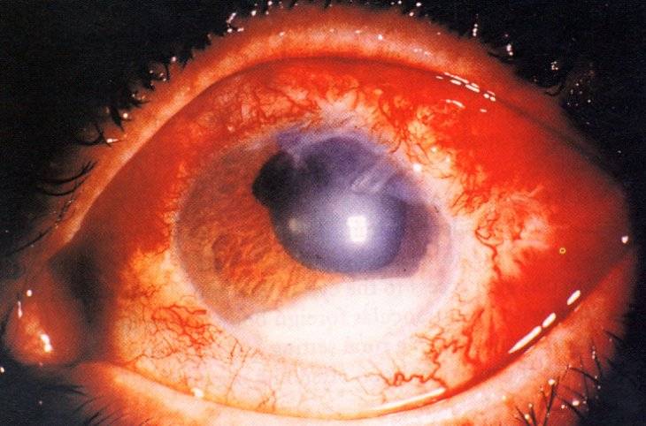 Кератит глаз: чем опасно это заболевание и как с ним бороться