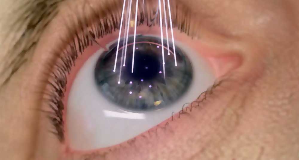 Лечение глаукомы лазером — лазерная трабекулопластика, иридэктомия, иридотомия