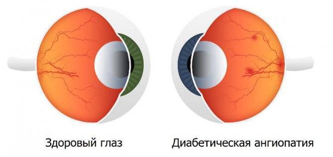 Лечение ангиопатии сетчатки глаза у ребенка