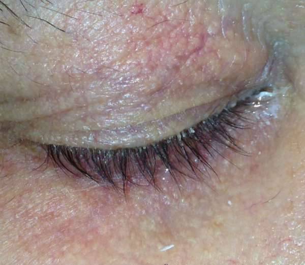Симптомы и лечение демодекоза глаз у человека
