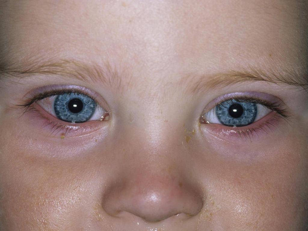 Аллергический конъюнктивит у ребенка: причины, симптомы и капли для лечения