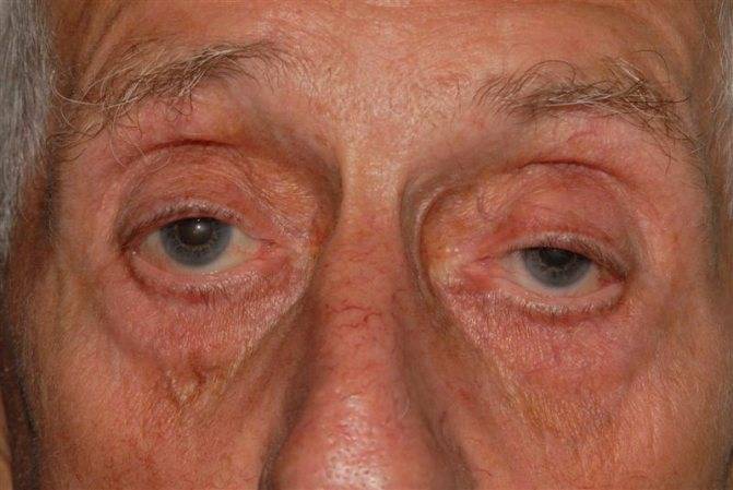 Причины слезотечения одного глаза и методы лечения