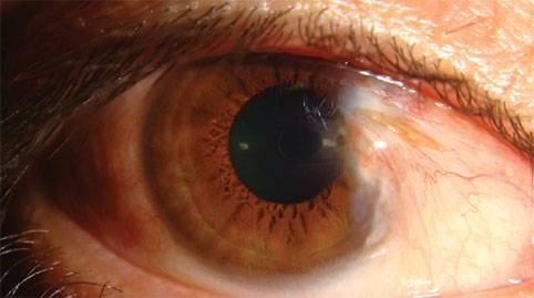 Птеригиум глаза: фото болезни после операции, степени птеригиума и лечение народными средствами