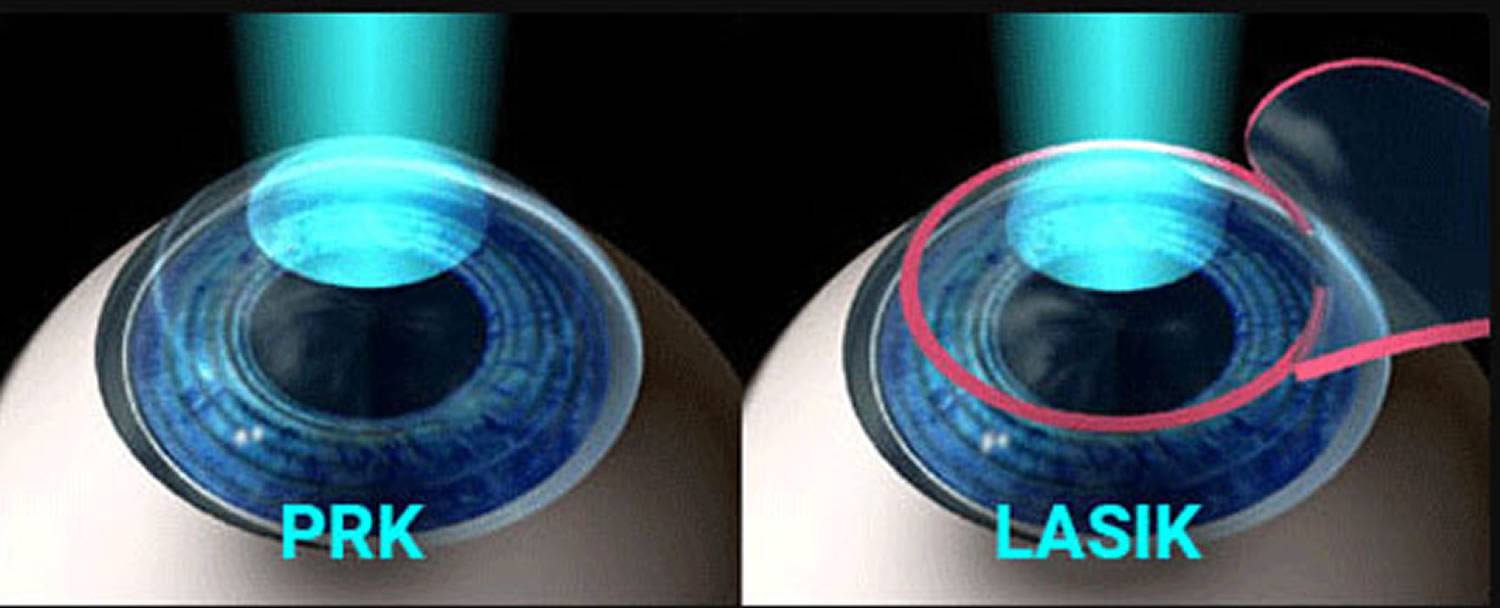 Коррекция зрения методом ласик или фрк: что лучше, безопаснее и эффективнее