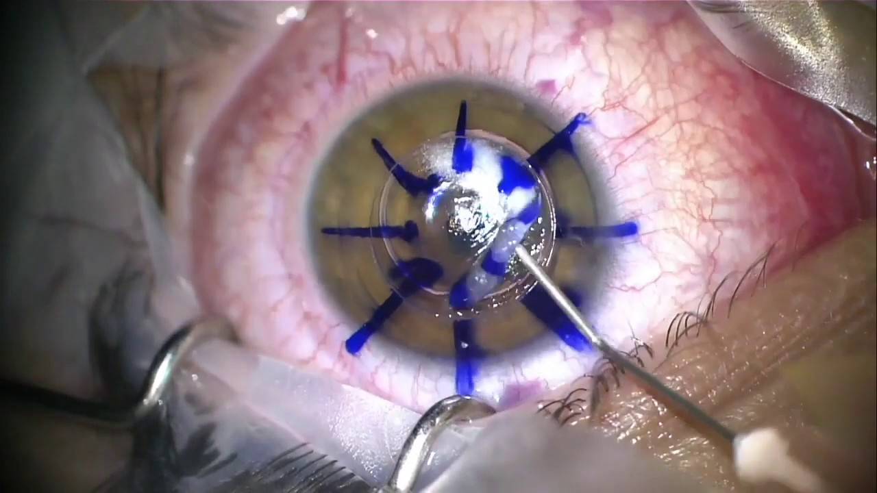 Что такое склеропластика глаз у детей и каковы отзывы об этой операции