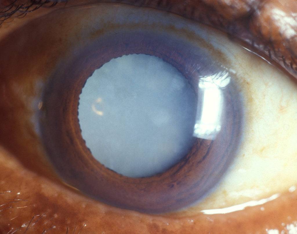 Перезрелая катаракта - нужна ли операция