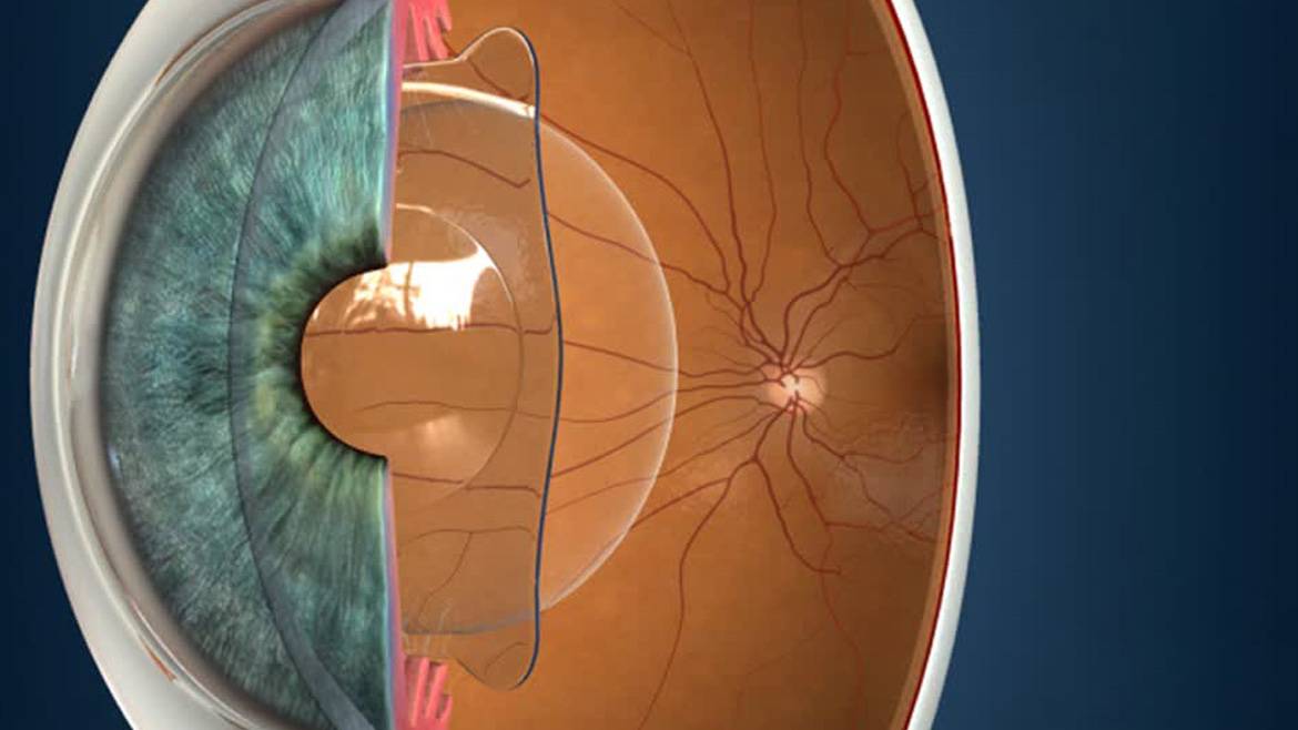 Причины для проведения артифакии глаза — рекомендации врачей