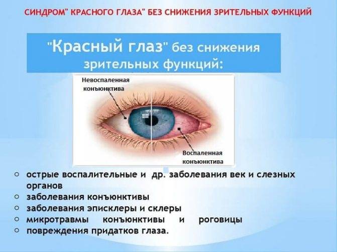 Воспаление глаза: причины, симптомы (покраснение слизистой), чем промыть глаза и лечить воспалительные заболевания у ребенка и взрослого, капли, народные средства, ромашка