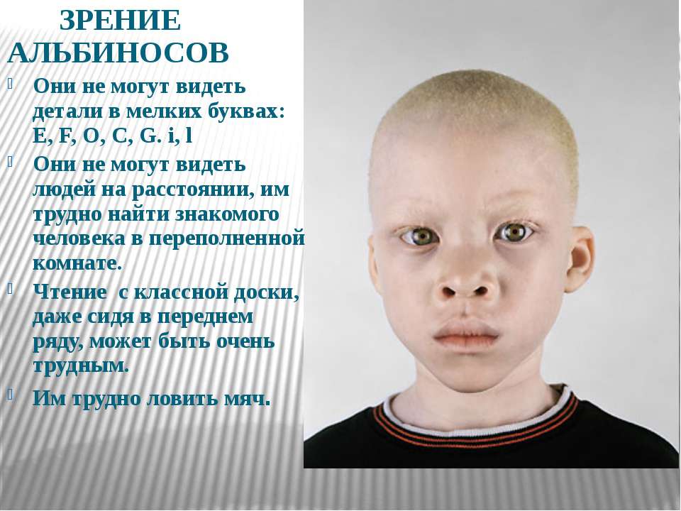 Человек - альбинос: 8 типов альбинизма, 4 ведущих симптома и о прогнозе жизни для особенных людей
