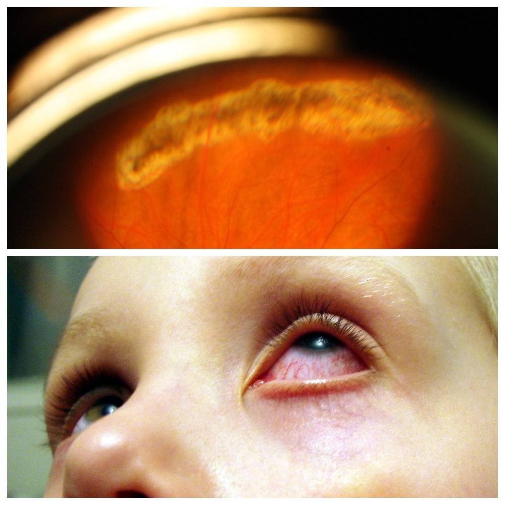 Как проводится лечение поврежденной роговицы глаза?