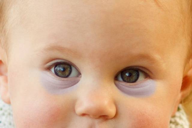 Отёки, мешки и синяки под глазами ребёнка. что делать родителям? | здоровье детей