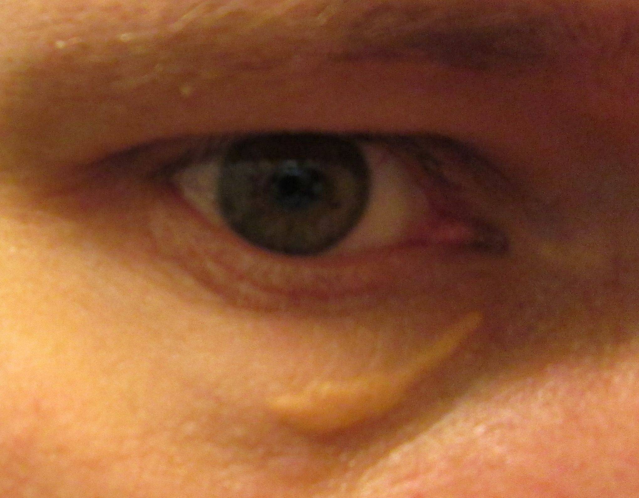 Желтые пятна на веках глаз — причины и лечение