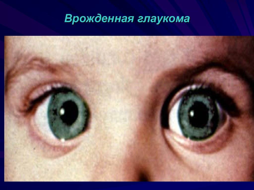 Врожденная глаукома у детей: фото, причины, симптомы, классификация