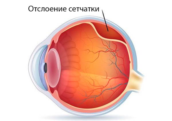 Отслойка сетчатки глаза: причины, симптомы, лечение