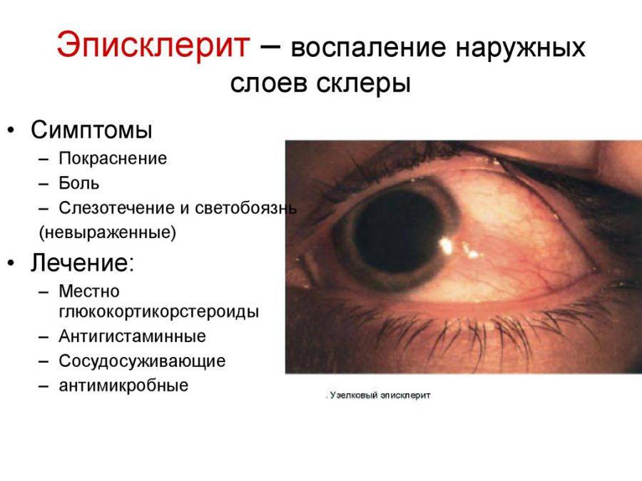 Кератит - симптомы, диагностика и лечение язвы роговицы глаза
