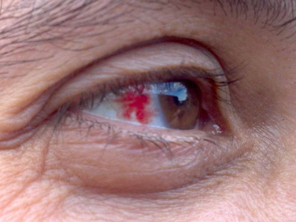 Как убрать кровоизлияние в глазу | медик03