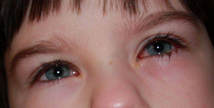 Основные причины покраснения глаз при простуде
