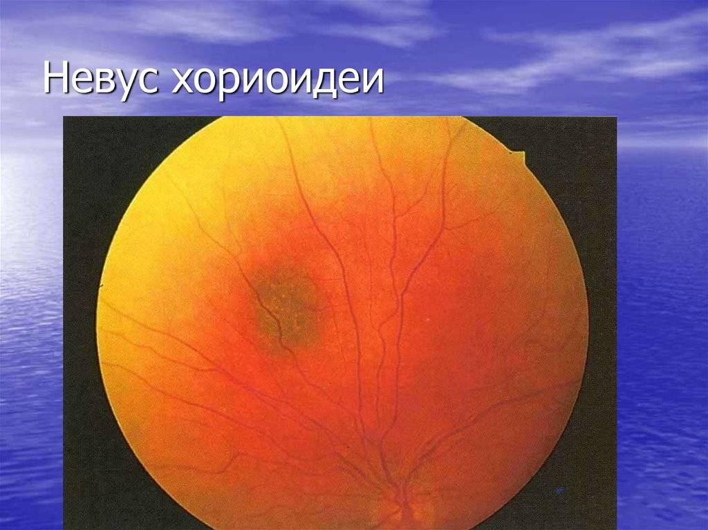 Меланома хориоидеи глаза - что это такое, почему возникает, как правильно определить, прогноз на жизнь