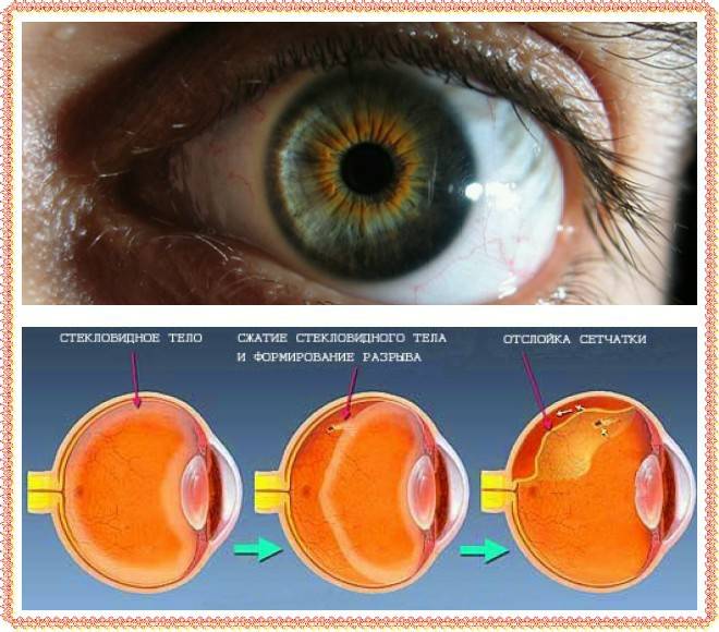 Разрыв сетчатки глаза: причины, симптомы, последствия и лечение