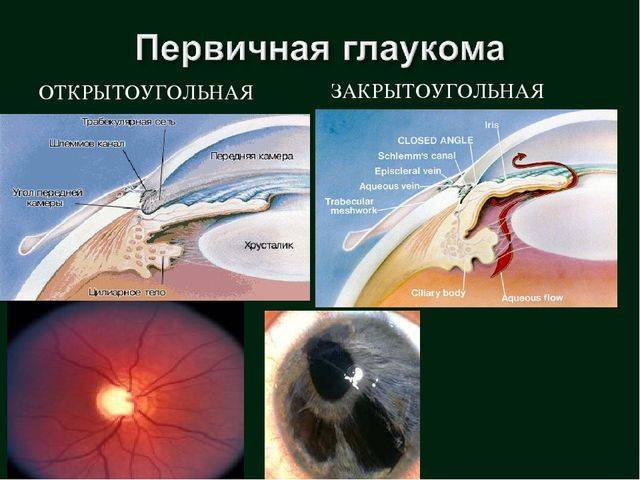 Закрытоугольная и открытоугольная глаукома - отличия, в чем разница