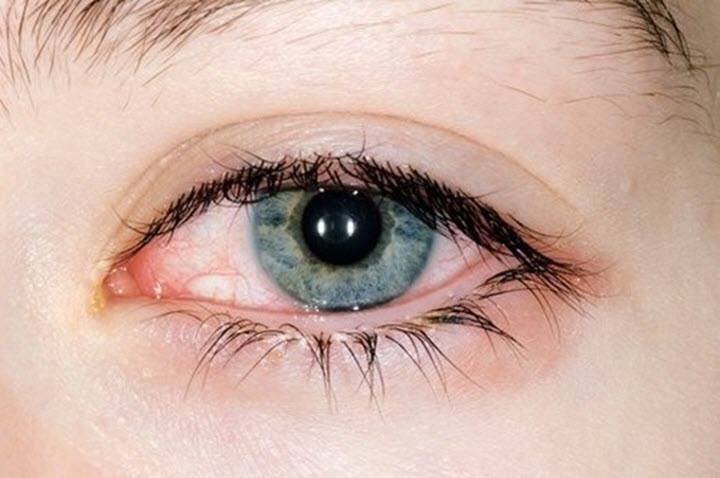 Основные причины и симптомы воспаления сосудистой оболочки глаза
