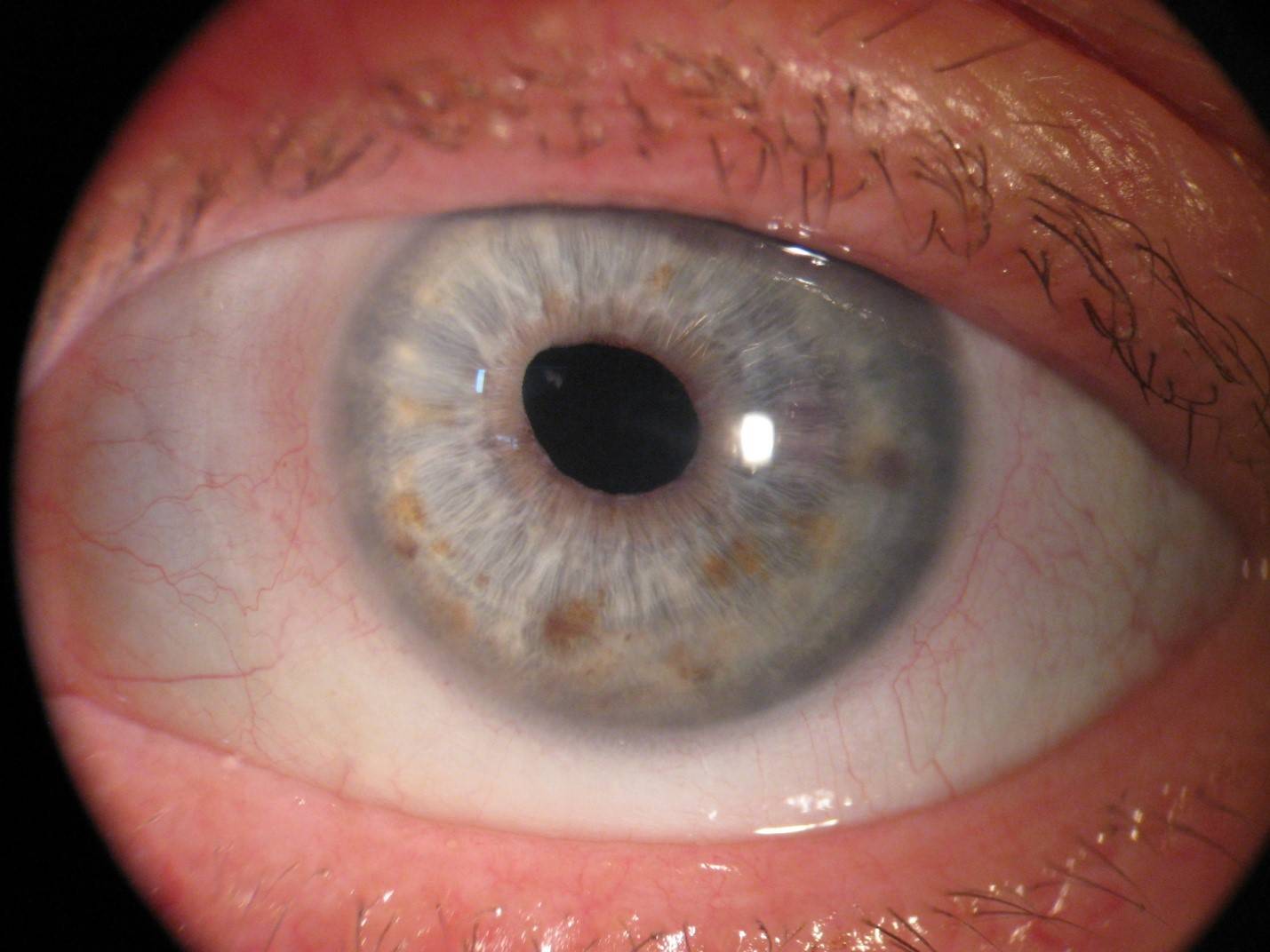 Трансплантация роговицы глаза: операция, отзывы, клиники, цены