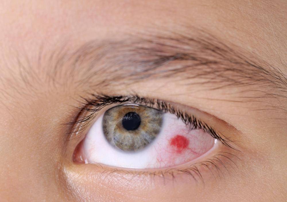 Красные пятна под глазами: причины, лечение, симптомы (точки шелушатся, чешутся, появляются после рвоты) у взрослых и детей