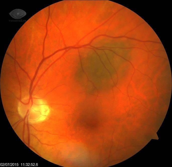 Невус хориоидеи на глазу – виды, симптомы и лечение (фото)