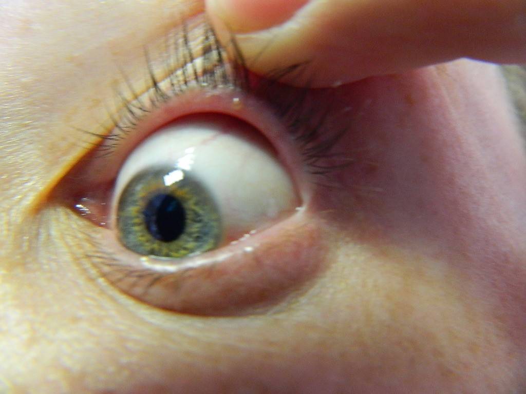 Пузырь на глазном яблоке: как распознать, диагностика