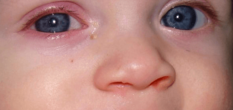 Гноятся глаза у ребёнка: что делать и чем лечить