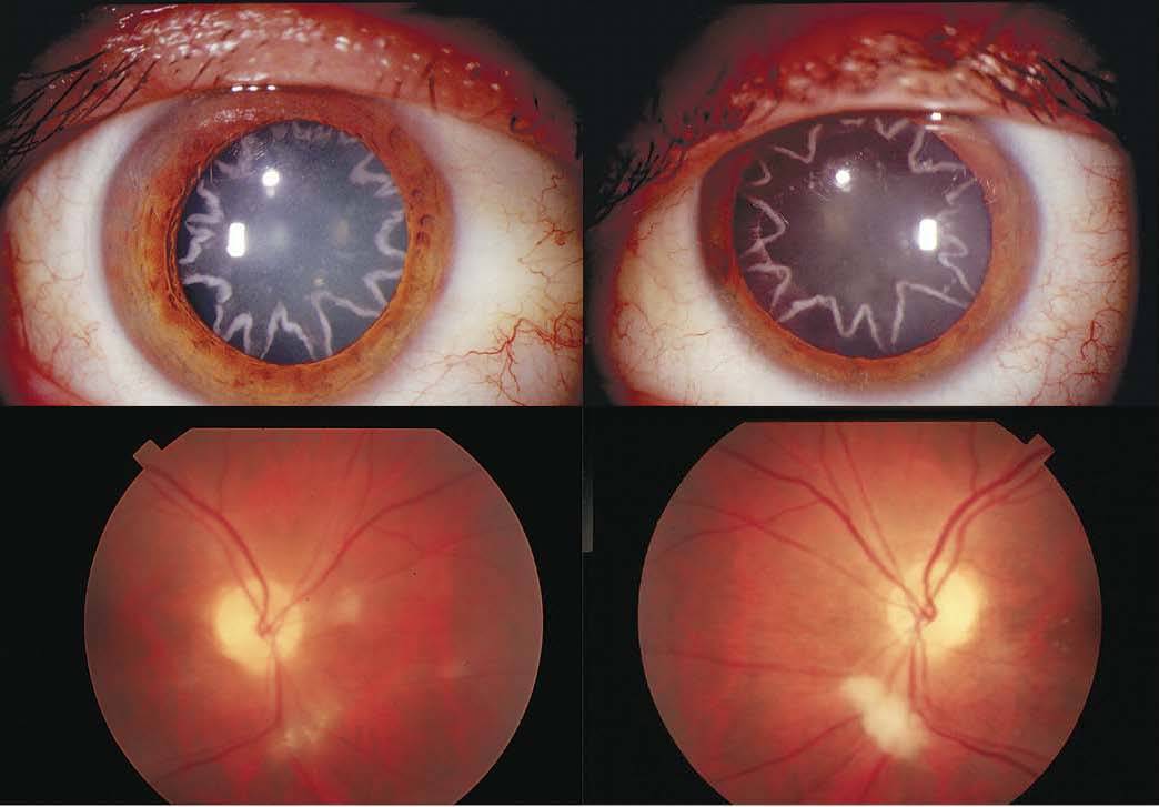 Как начинается катаракта глаза – основные симптомы