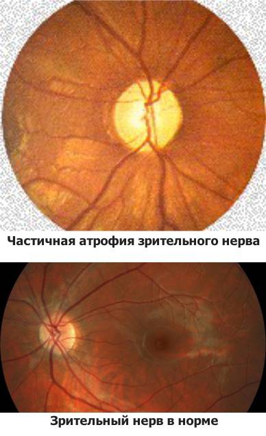 Симптомы и причины атрофии зрительного нерва