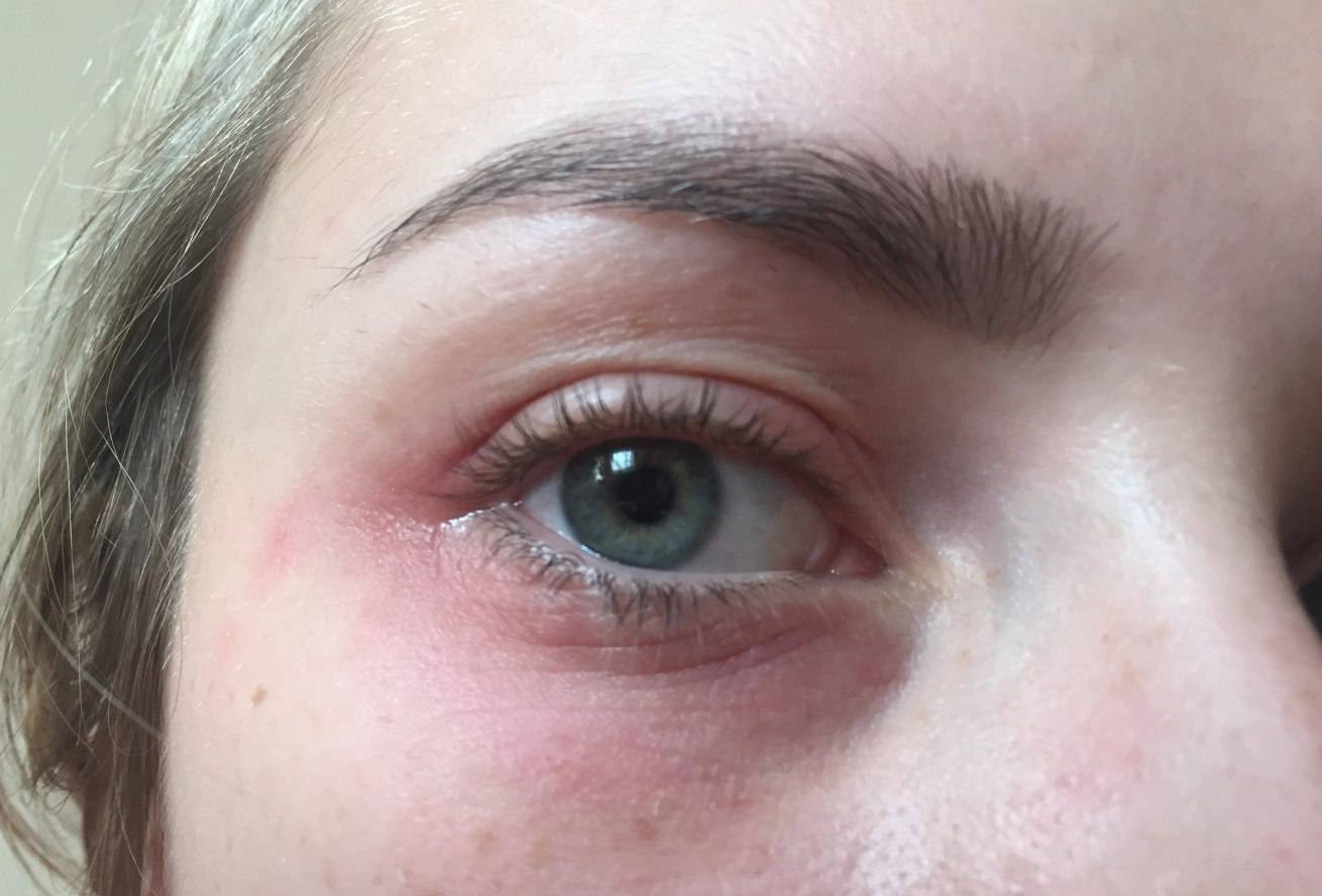 Что нужно знать об аллергии на веках глаз