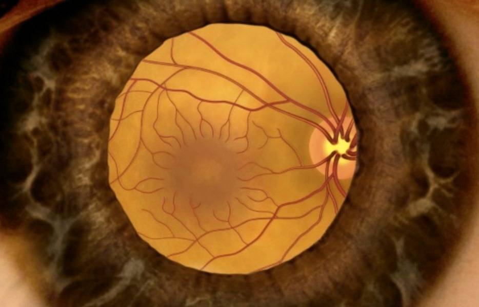 Ксантопсия - что это, причины и лечение - про глаза