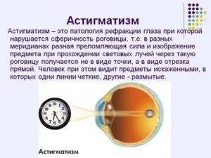 Гиперметропический астигматизм: причины, симптомы, лечение, виды (сложный, простой, прямой, обоих глаз и одного), диагностика, что это такое, профилактика