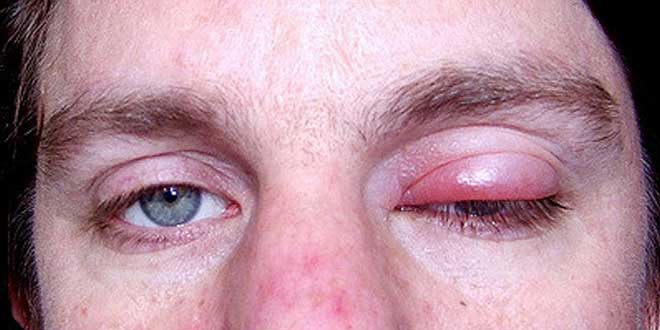 Правильное лечение герпеса на веках и возможные осложнения для слизистой глаза